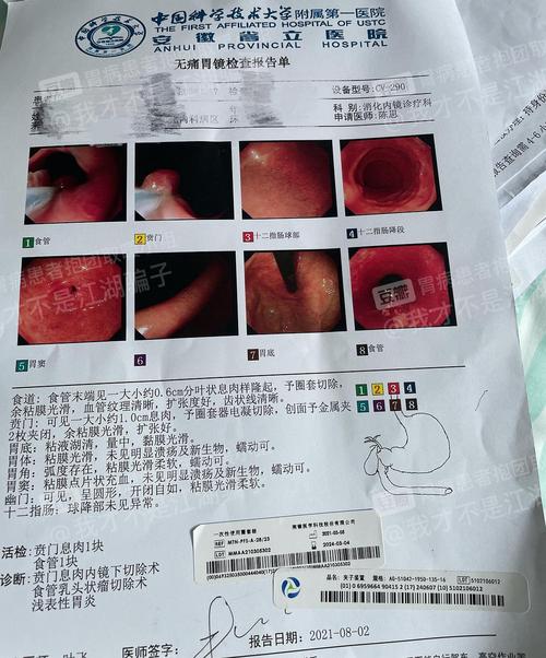 食管隆起返流胃息肉
