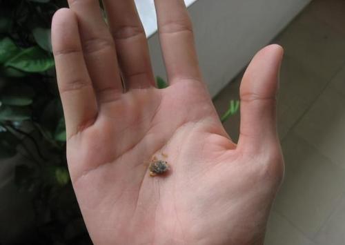 油耳朵和干耳朵,哪种更健康?油耳朵中的"油"到底是什么?