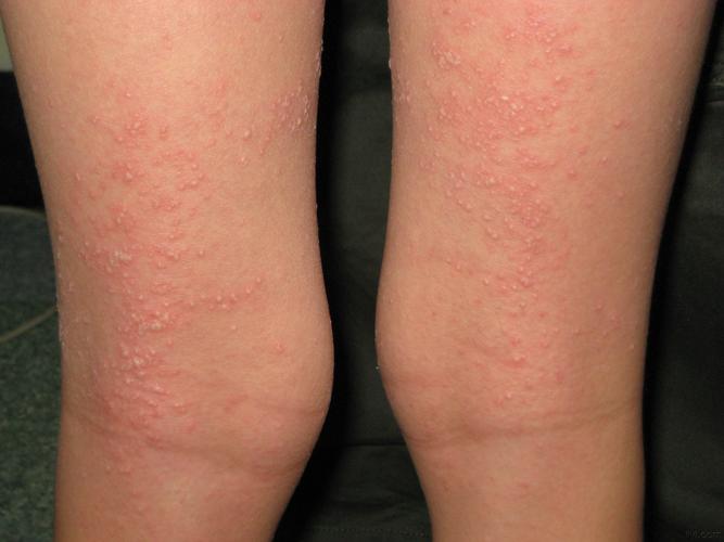 发热,咽痛5天,皮疹3天