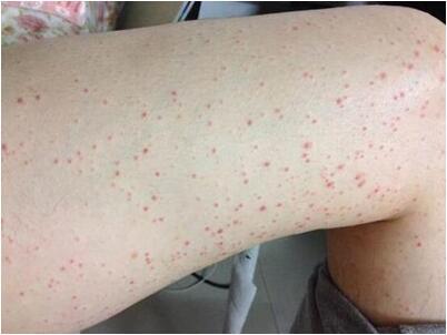 过敏性紫癜最常见的类型