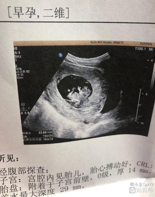 孕10周 2天的b超单,好可爱 这是小手