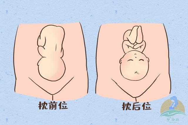 不论是枕前位还是枕后位,只要是头位,绝大多数宝宝都是可以顺产的.