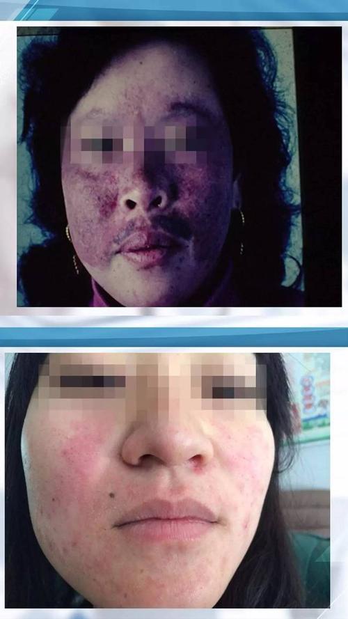 这两张图片究竟哪张是过敏,哪张又是红斑狼疮呢?