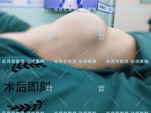 动感隆胸案例(35)不对称乳腺萎缩后的假体治疗即刻 (原创)