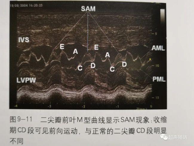 网易首页>正文申请入驻> 选自《心血管超声诊断学图解》赵博文主编
