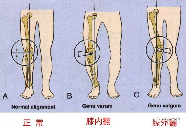 平均值13°-18°,临床测量常取髂前上棘,髌骨中心和胫骨粗隆三点的成