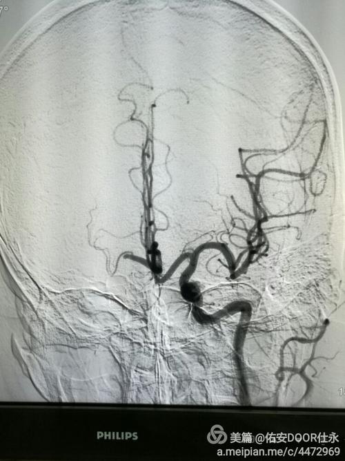 左侧颈动脉造影