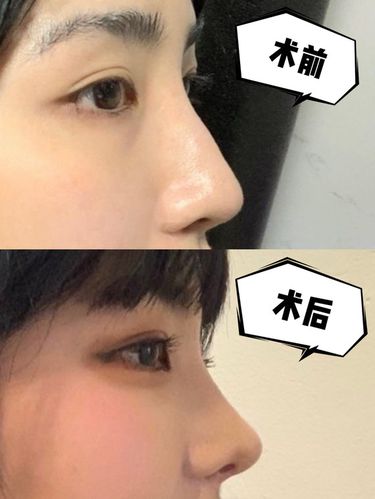 整形鼻子