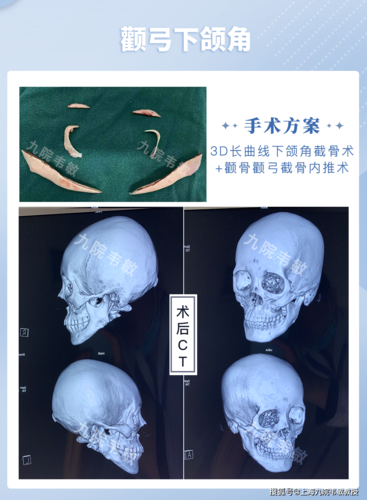 原创九院韦敏精讲丨颧弓下颌角手术带来面部轮廓的质变提升