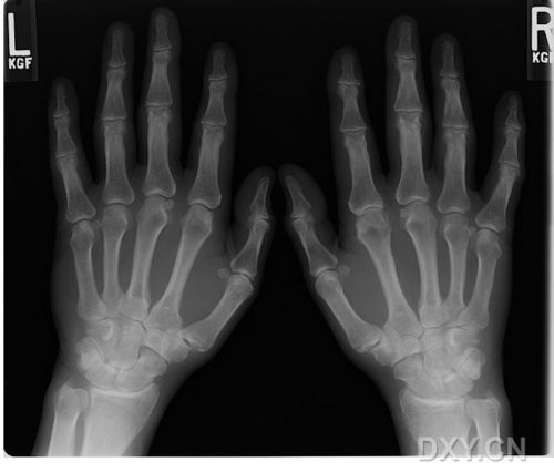 要一张左右手手掌骨骼图,x光的要,ct的图