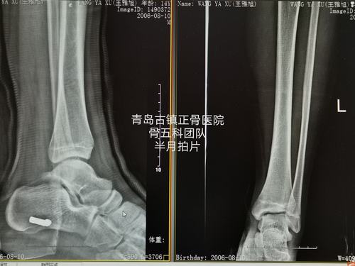 胫骨远端骨骺骨折(iv型)非手术治疗