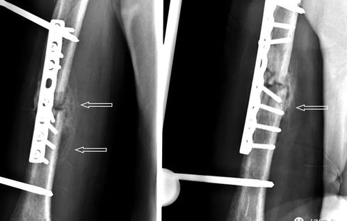 【影像表现】可见骨痂形成,但仍可见骨折线.