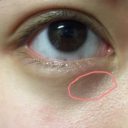 眼睛下面长的这种一粒粒的是什么?圈出来的地方 怎么样才能消掉?