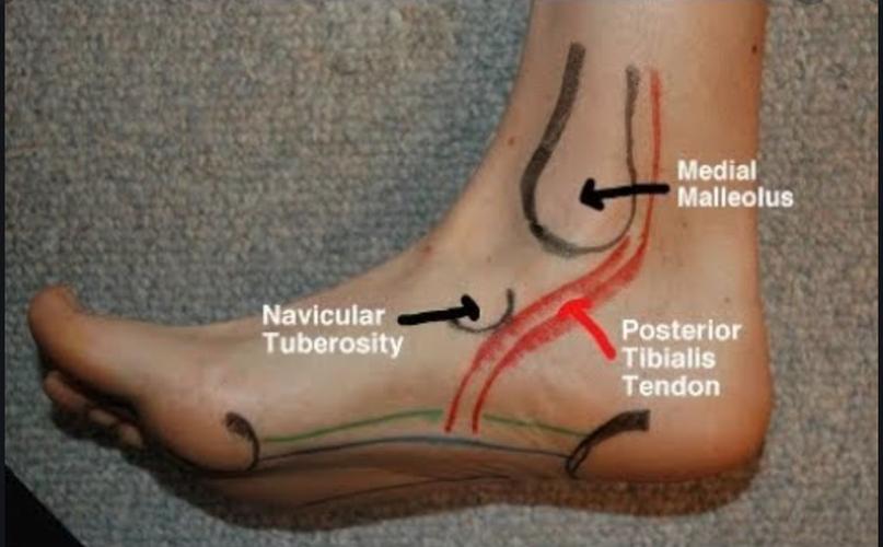 41 人 赞同了该文章 看到知乎上一些朋友在提问关于胫骨后肌肌腱炎的