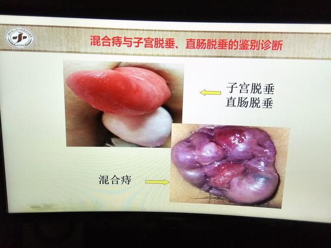 混合痔与子宫脱垂及直肠脱垂鉴别