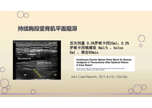 就是操作简单且安全,镇痛效果明确,超声下横突及肌肉间隙图像容易识别