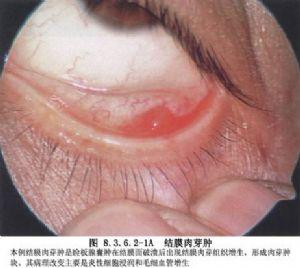 结膜囊肿摘除术