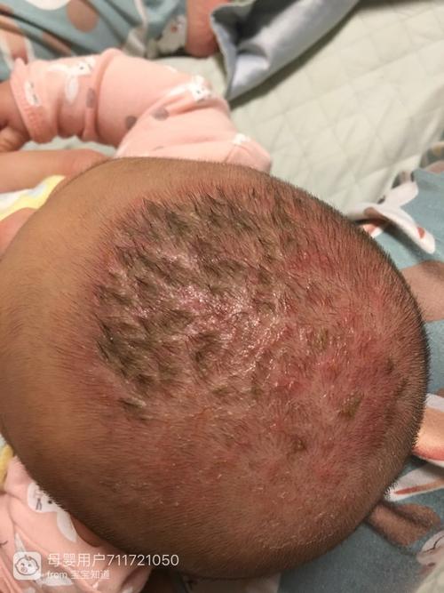 三个月宝宝头上有头垢,然后又长红疙瘩,又红又痒,宝宝