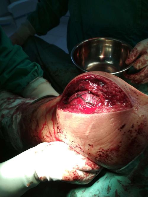 此为髌骨骨折手术