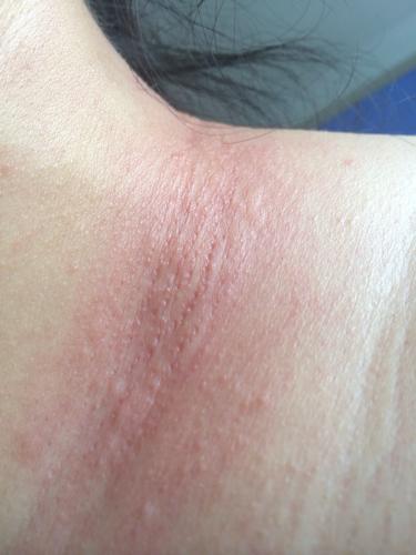 今年28岁,脖子的皮肤特别容易过敏,起一层小疙瘩很痒