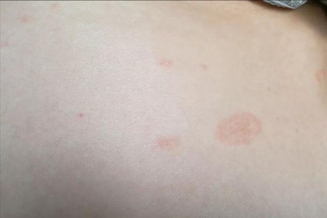 玫瑰糠疹会传染吗