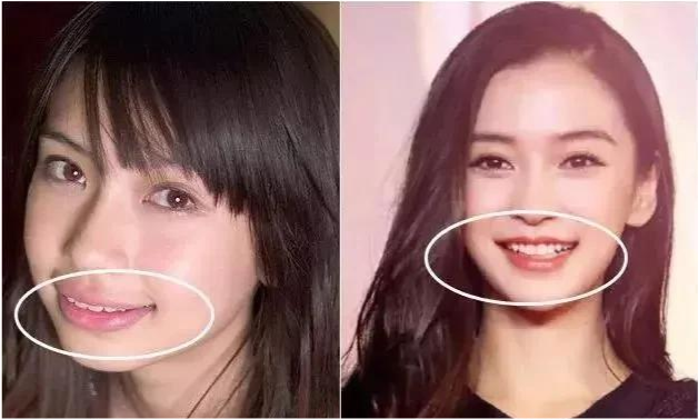 angelababy杨颖,颜值发生翻天覆地变化一个最重要的项目就是矫正牙齿