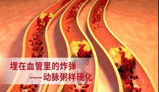 血管里的斑块长什么样儿?