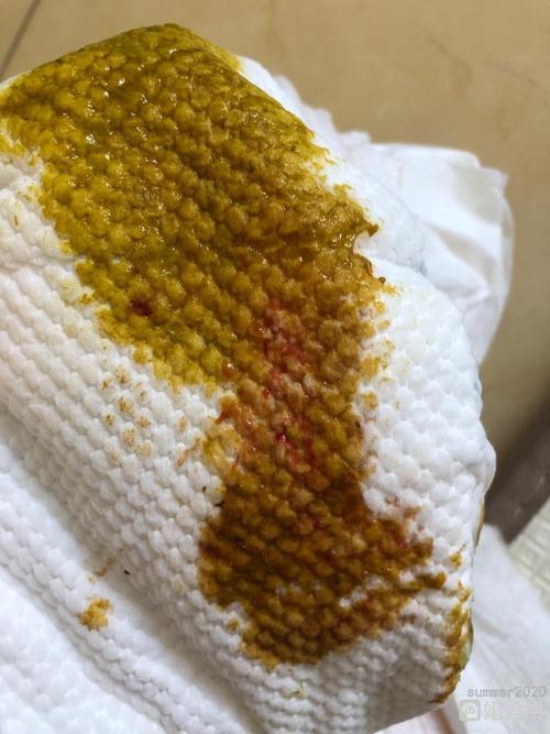 有没有宝妈遇到过宝宝7个月宝宝肛裂的,大