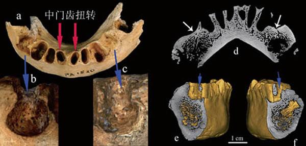 a,b中红色示断裂的齿槽管;c为冠状面切片示,牙骨质增生部位内部结构;d