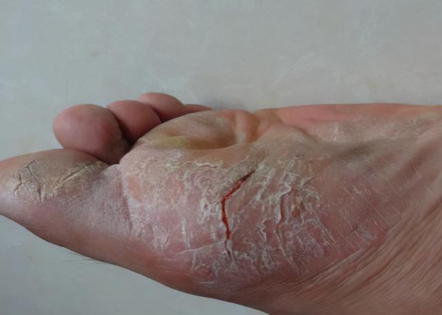 一到秋天脚部就出现干裂脱皮医生说可能跟这些有关