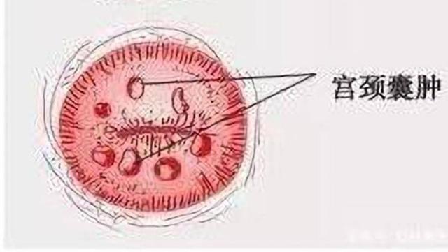 女性课堂:宫颈糜烂并非疾病,宫颈囊肿是宫颈的"青春痘"