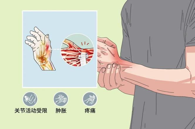 得了"腱鞘炎"不要担心!针刀疗法帮您快速治愈!