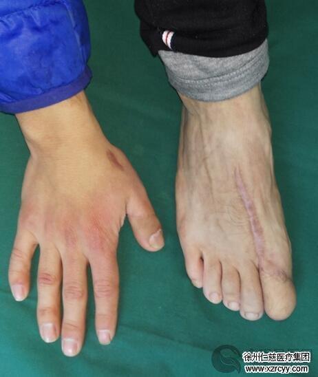 徐州仁慈医院手外科"移花接木"再植拇指 脚趾变手指