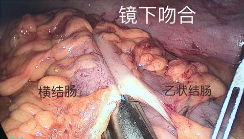 降乙交接肿瘤合并完全性肠梗阻治疗——根治手术 一期