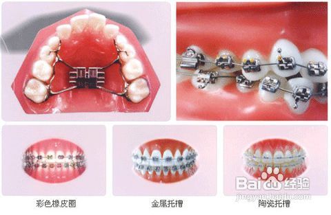 3  3,固定矫治器:最为常用的矫正器.