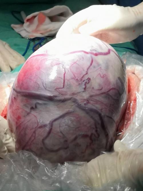 巨大卵巢恶性肿瘤占满整个盆腹腔!取出肿瘤震惊在场医务人员!