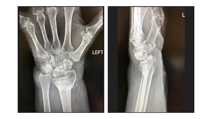 桡骨远端骨折畸形愈合怎么办?