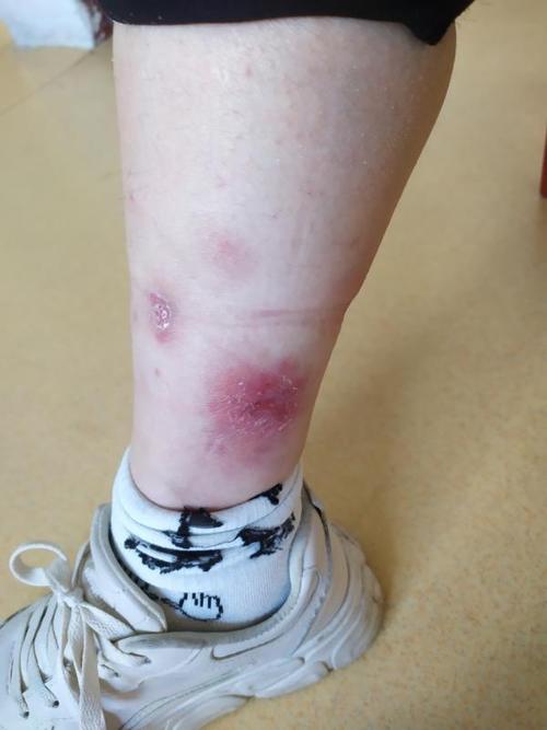 皮肤破溃两个月难愈合 南阳17岁女孩竟患上皮肤结核