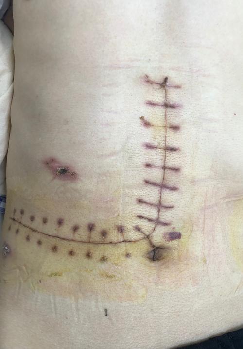 沁源县人民医院普外科成功开展胃癌根治联合右半肝切除术