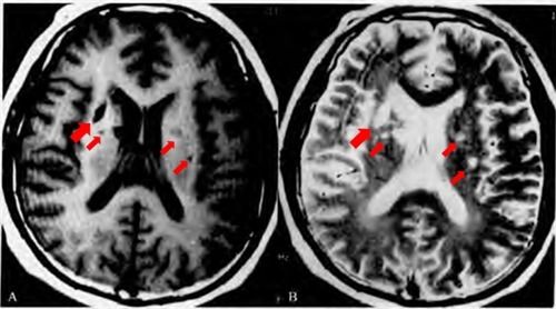 手把手教程:脑梗死影像读片入门
