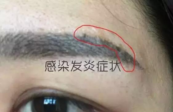 半永久纹眉后留疤,这个锅谁背?