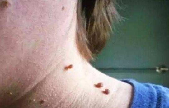 身上为什么会长出小肉疙瘩身体在向你表达什么呢