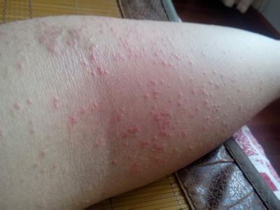 临床上湿疹有哪些明显的症状特征表现