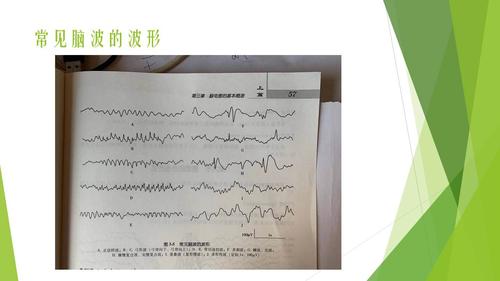 【连载】5癫痫脑电图的解析-癫痫的脑电图诊疗技术
