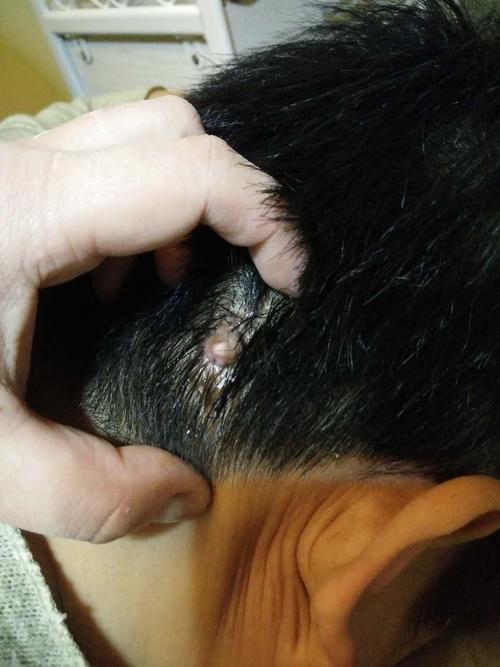 仅售10元,价值20元痣痦疣瘊处理体验,节假日通用!