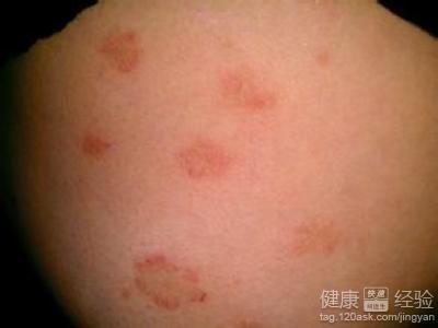 玫瑰糠疹吃什么食物好
