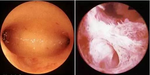 可以考虑应用宫腔镜手术去除各种不良影响,如:子宫内膜息肉,宫腔粘连