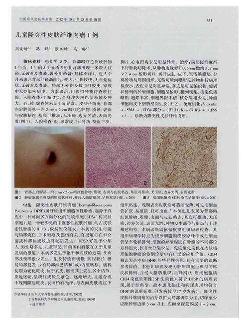 期刊儿童隆突性皮肤纤维肉瘤1例      临床资料患儿男,8岁.