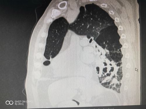 支气管扩张,自发性气胸,肺复张术后,痰液潴留,经支气管镜吸痰处理后