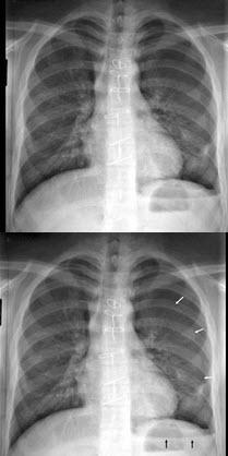 由35支终末细支气管组成的肺结构称为
